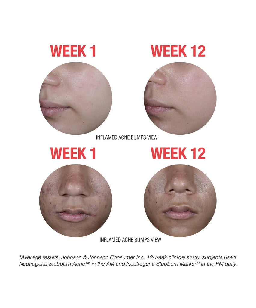Stubborn Acne AM Treatment 56g
